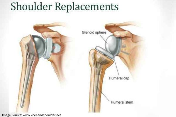 Preparing for Shoulder Replacement Surgery