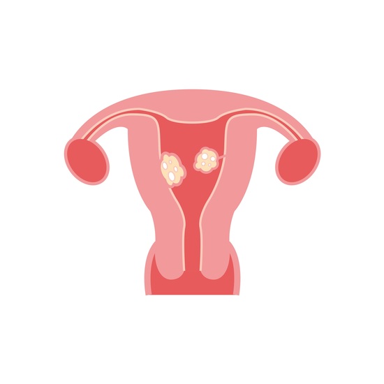 FIBROIDS AND ITS AFTER-EFFECTS AND TREATMENTS