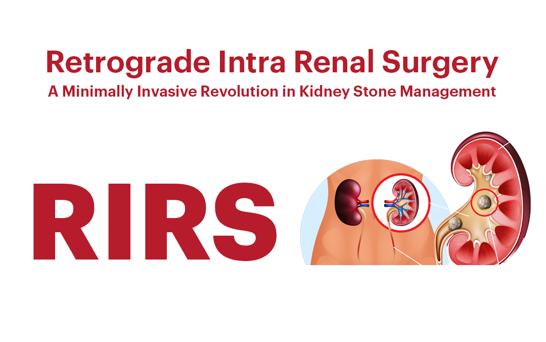 RIRS (Retrograde Intra Renal Surgery): A Minimally Invasive Revolution in Kidney Stone Management