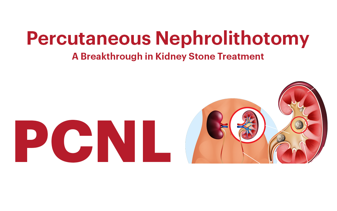 Percutaneous Nephrolithotomy (PCNL): A Breakthrough in Kidney Stone Treatment