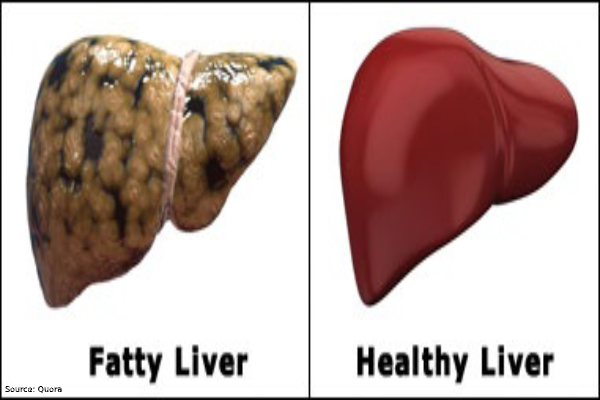 how to overcome fatty liver
