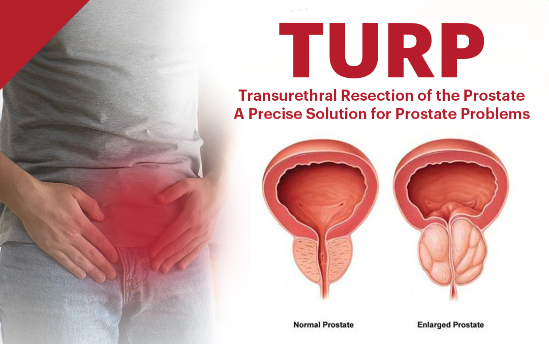Transurethral Resection of the Prostate (TURP): A Precise Solution for Prostate Problems