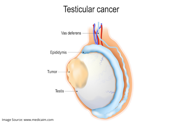 testicular lump